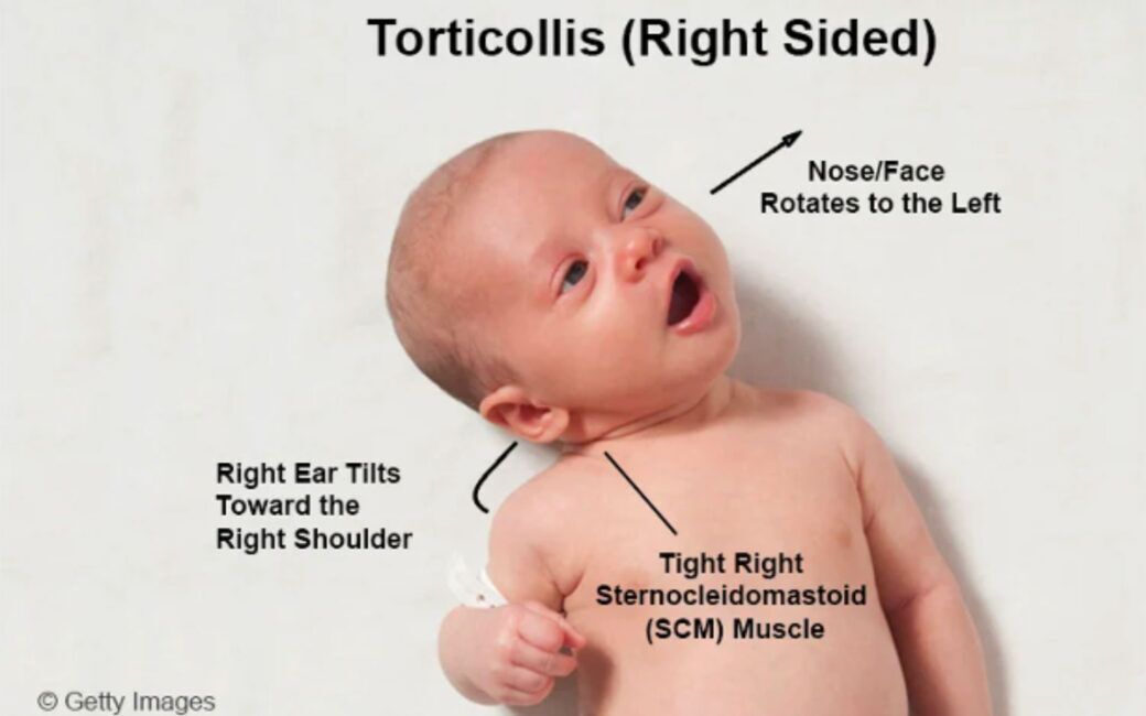 What you need to know about torticollis